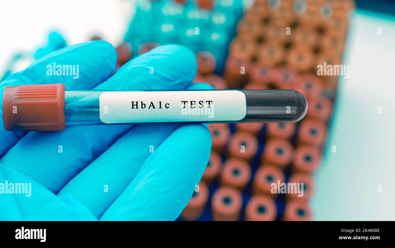 Haemoglobin A1c blood test, conceptual image Stock Photo Alamy