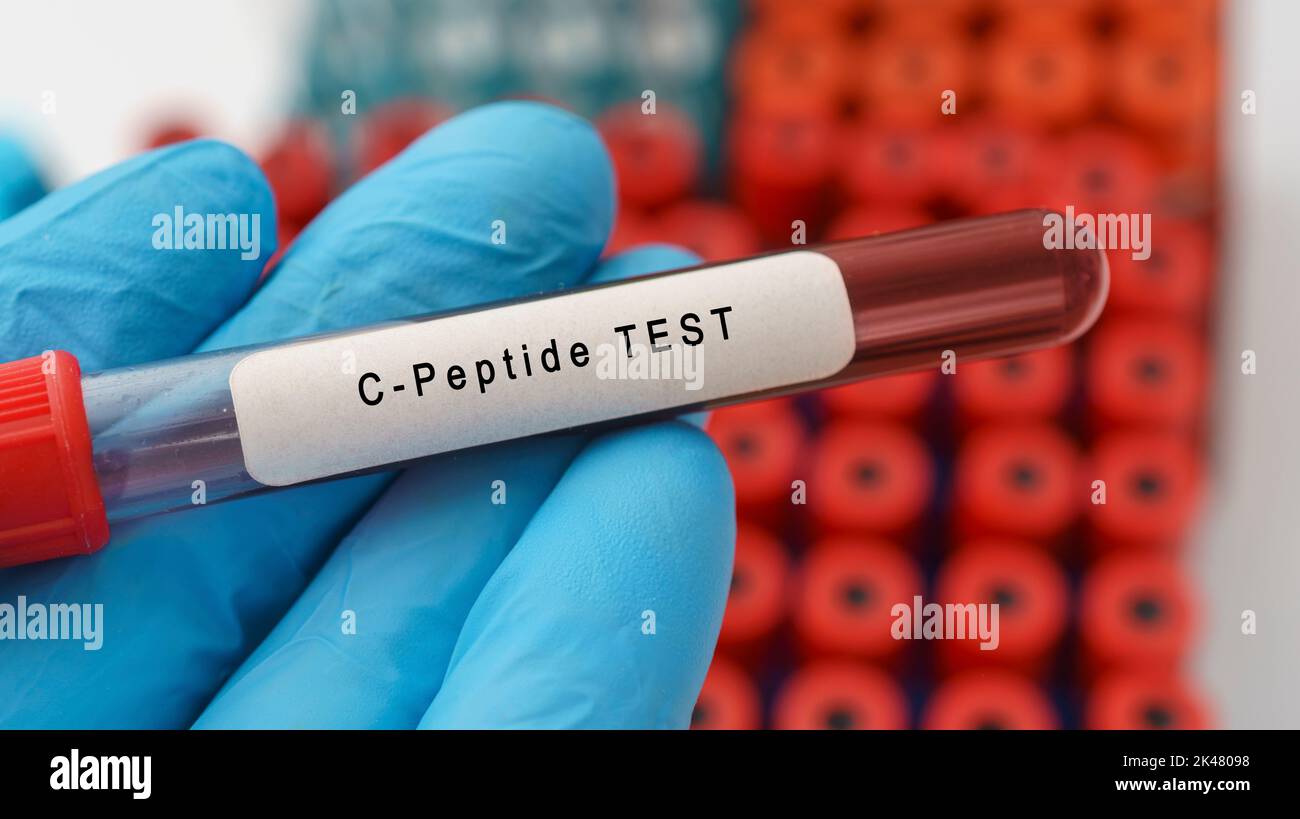 CPeptide diabetes blood test, conceptual image Stock Photo Alamy