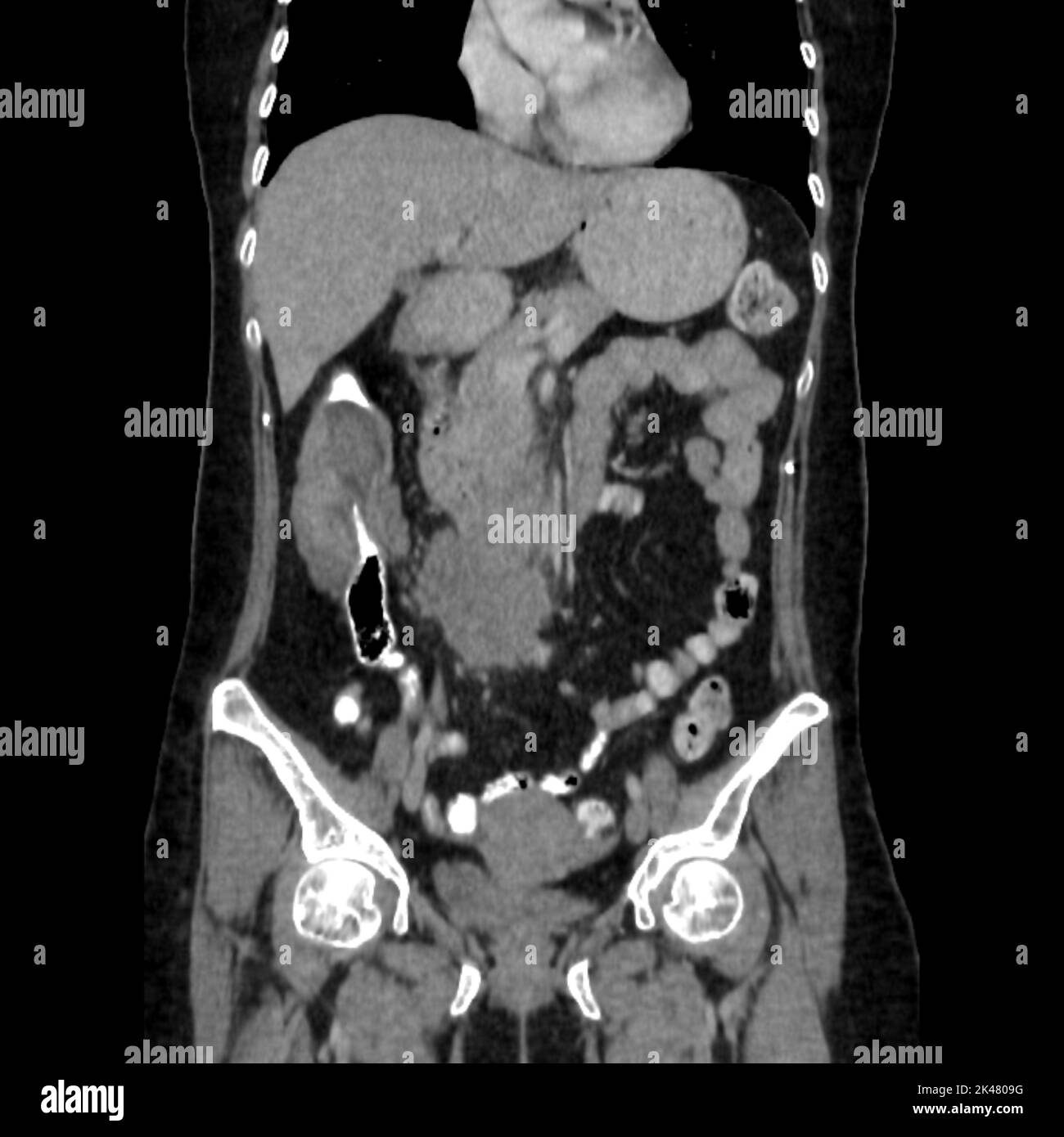 Intussusception of the intestines, CT scan Stock Photo