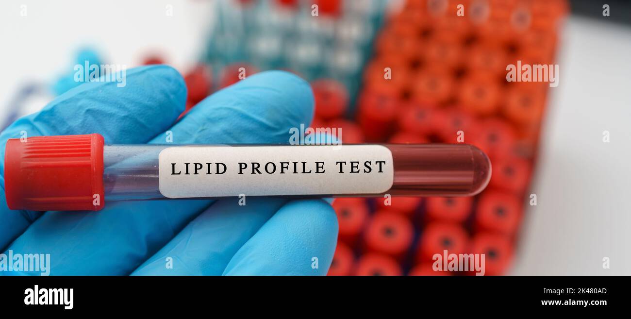 Lipid profile test, conceptual image Stock Photo - Alamy