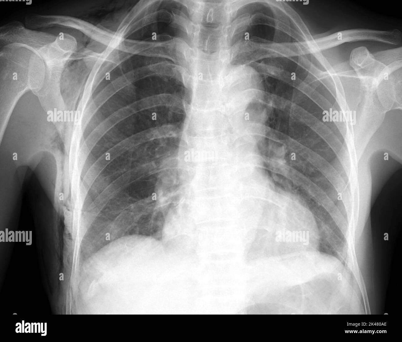 Subcutaneous emphysema, X-ray Stock Photo