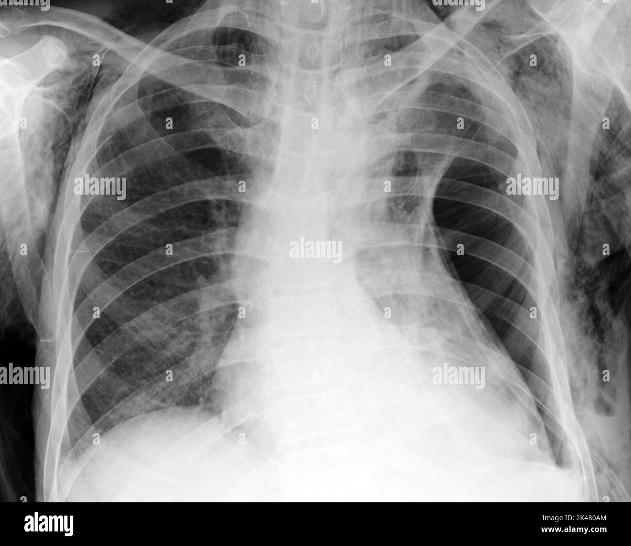 Subcutaneous emphysema, X-ray Stock Photo