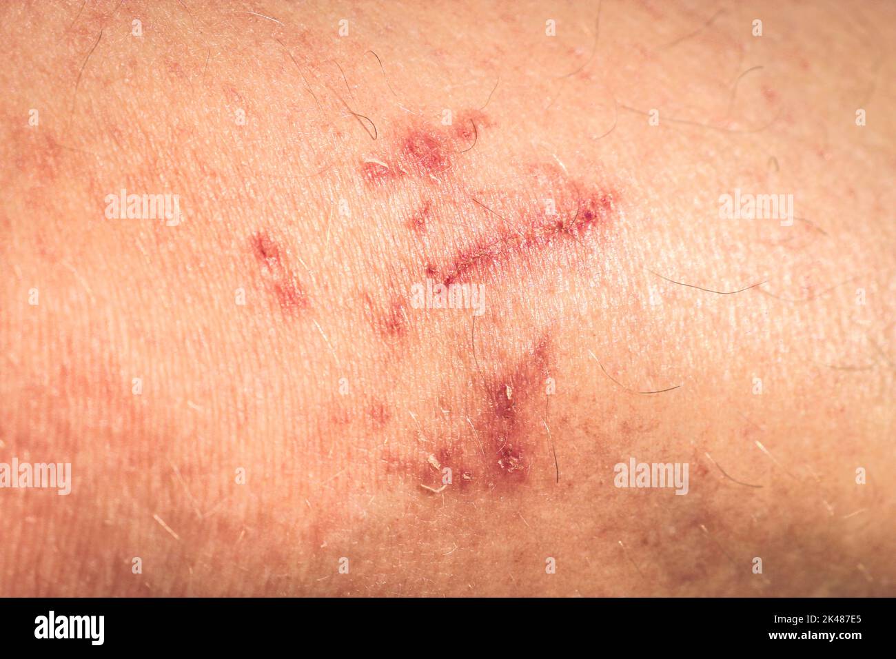 Close-up of scratches on the knee after a fall from a bicycle. Wound on the skin. Stock Photo