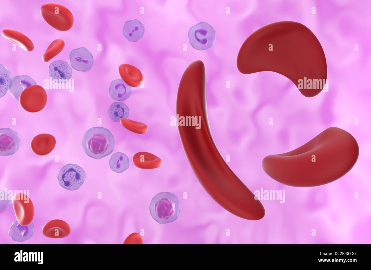 Sickle cell Anaemia (Sickle cell disease SCD) cells in the blood flow