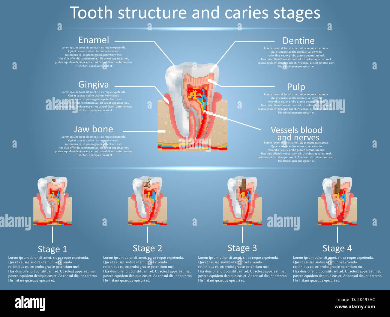 Human Tooth Structure Vector Diagram And Caries Stages Dental Anato ...