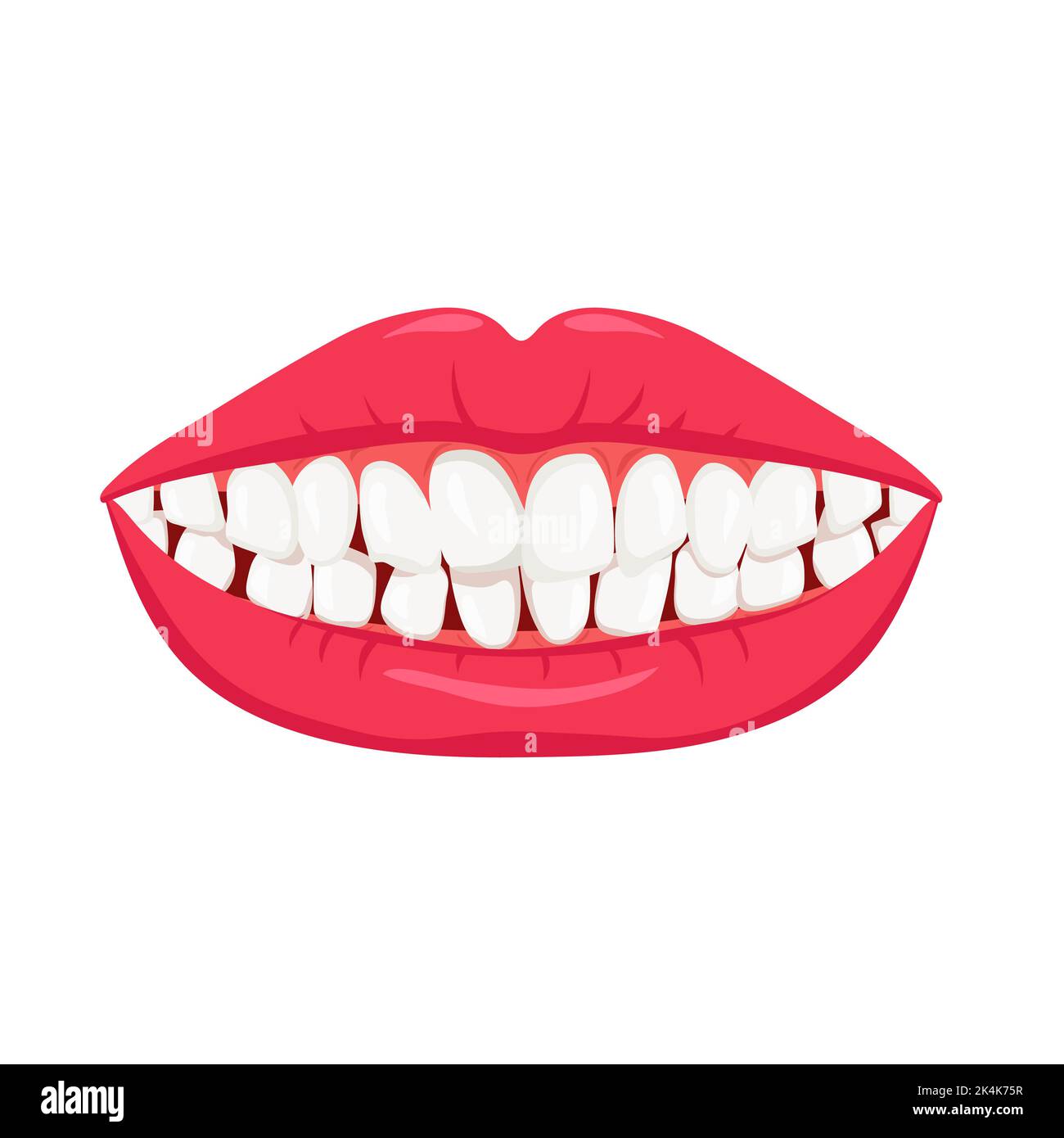 Smile with crooked teeth. White misaligned teeth with orthodontic