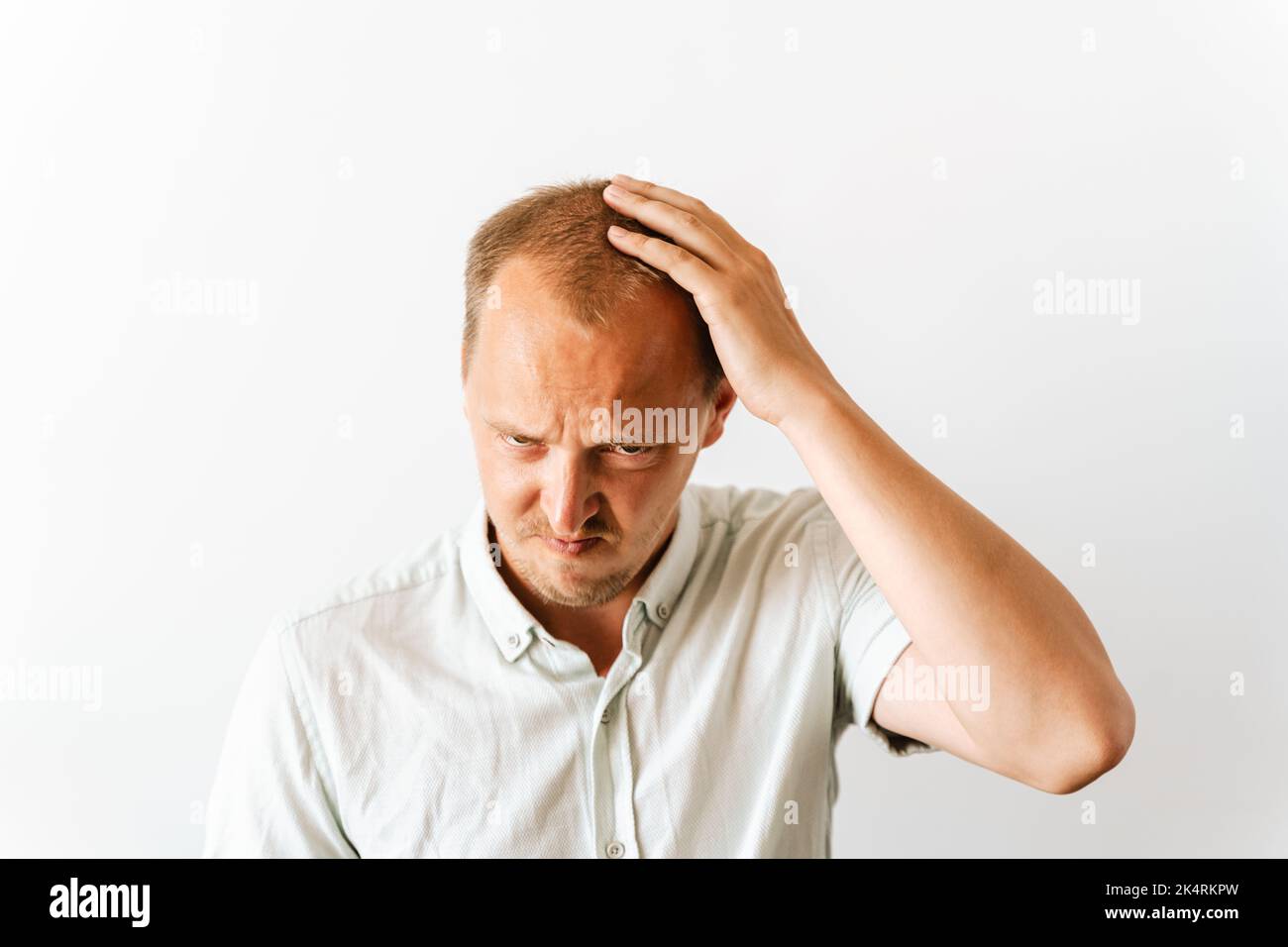 Young sad bald man with depression at hair loss problems looking angry and frustrated and holding his head. Before hair transplantation Stock Photo