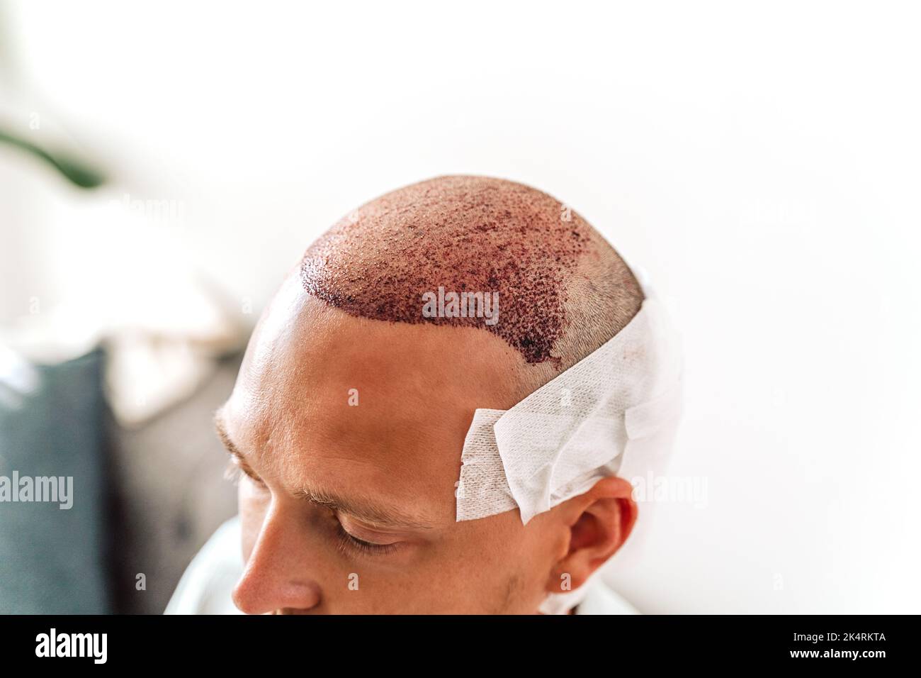 After hair transplantation surgical technique that moves hair follicles. Young bald man in