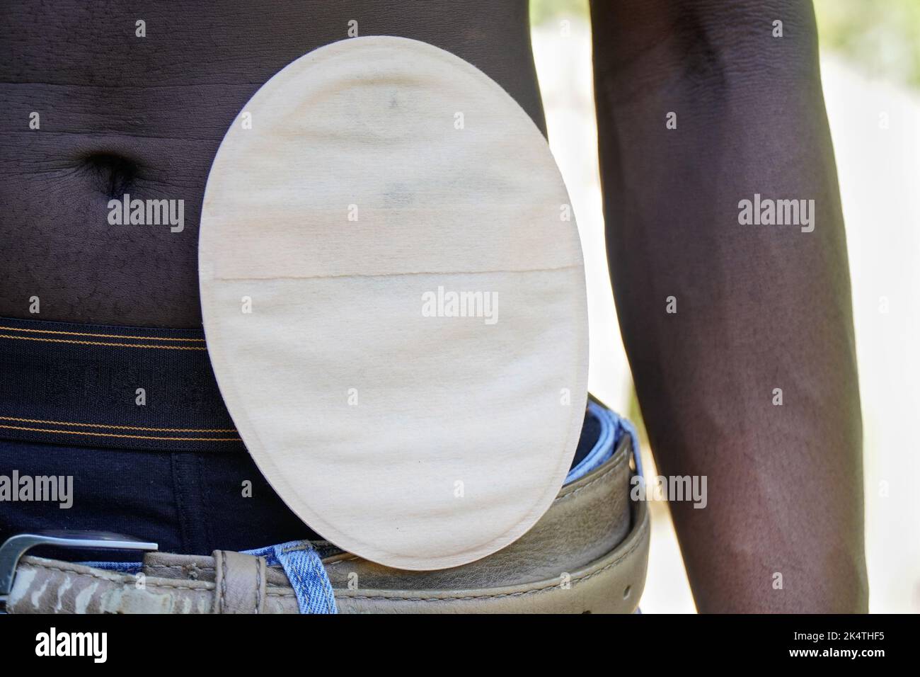 African person with a colostomy bag Stock Photo Alamy