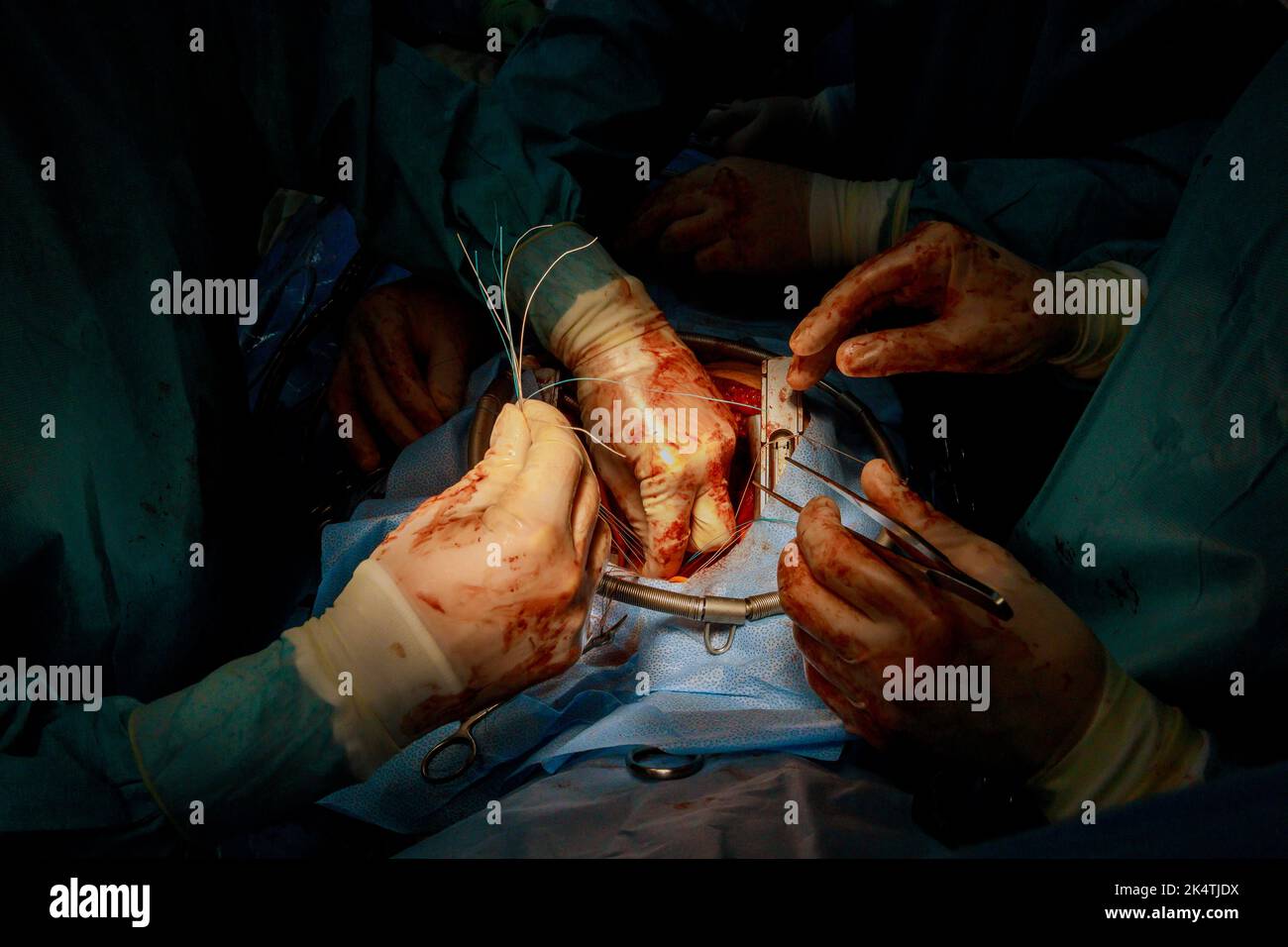 The coronary artery bypass graft CABG procedure is performed for heart operations due to coronary heart disease in the operating room of the hospital Stock Photo