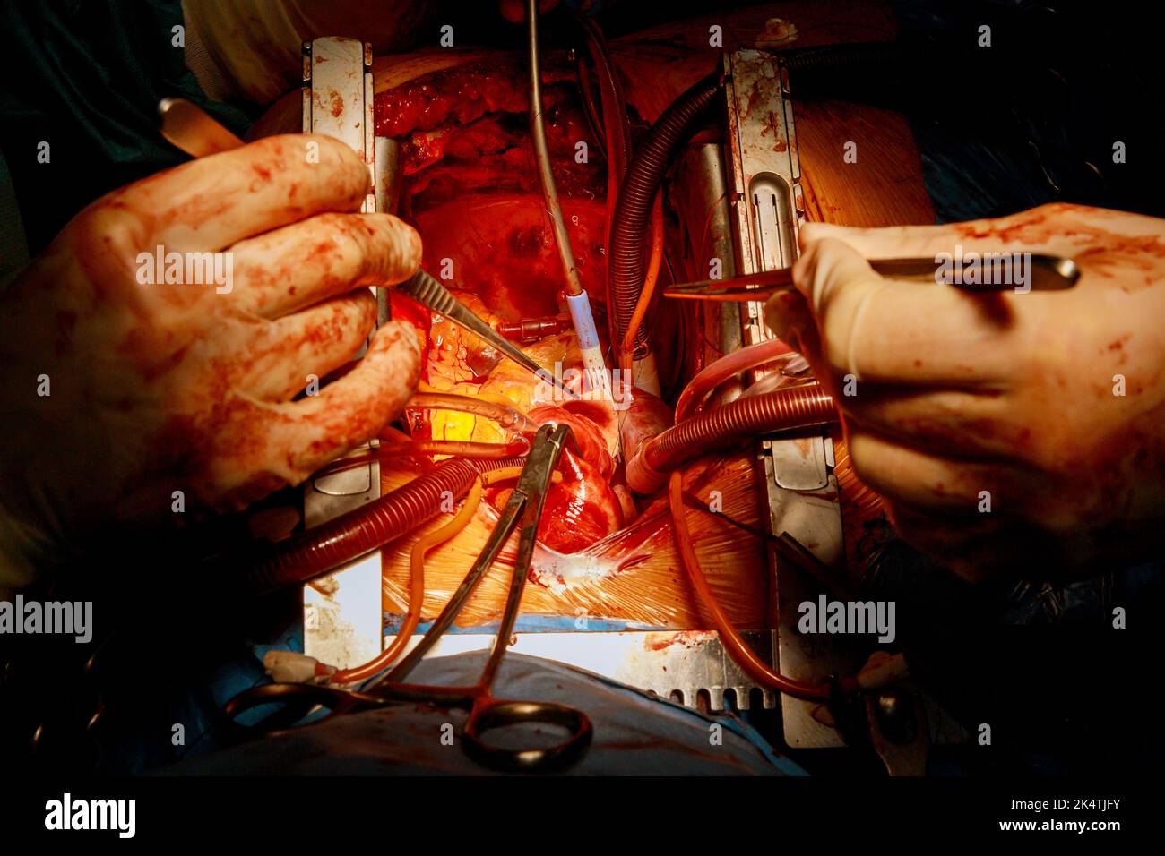 CABG is a type of bypass surgery used for heart operations caused by coronary heart disease in a hospital operating room owing to coronary heart Stock Photo