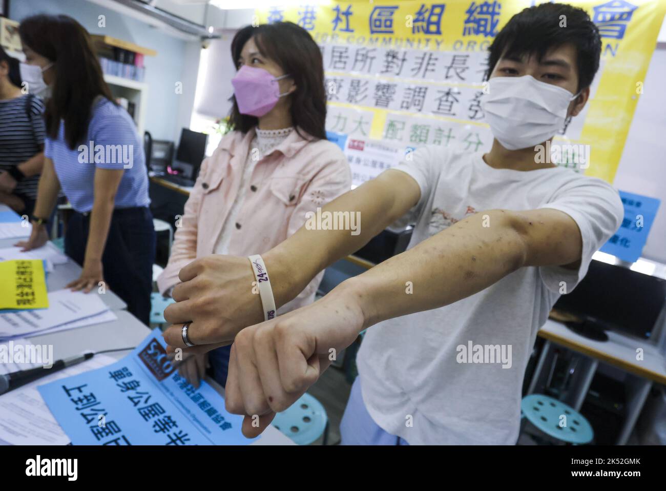 A resident of a subdivided flat, Curry (full name not provided) shows bed bug sores in a Society for Community Organization's (SoCo) press conference in which the organization calls for the merit point and quota system for non elderly singleton public housing applicants as well as reveals the survey results on their livelihood hardship and economic support, at the SoCo offices in Sham Shui Po.  The cityHH subdivided housing spaces, many of them windowless and plagued by hygiene and fire hazards, have been criticised for their poor living conditions.  02OCT22 SCMP / Jonathan Wong Stock Photo