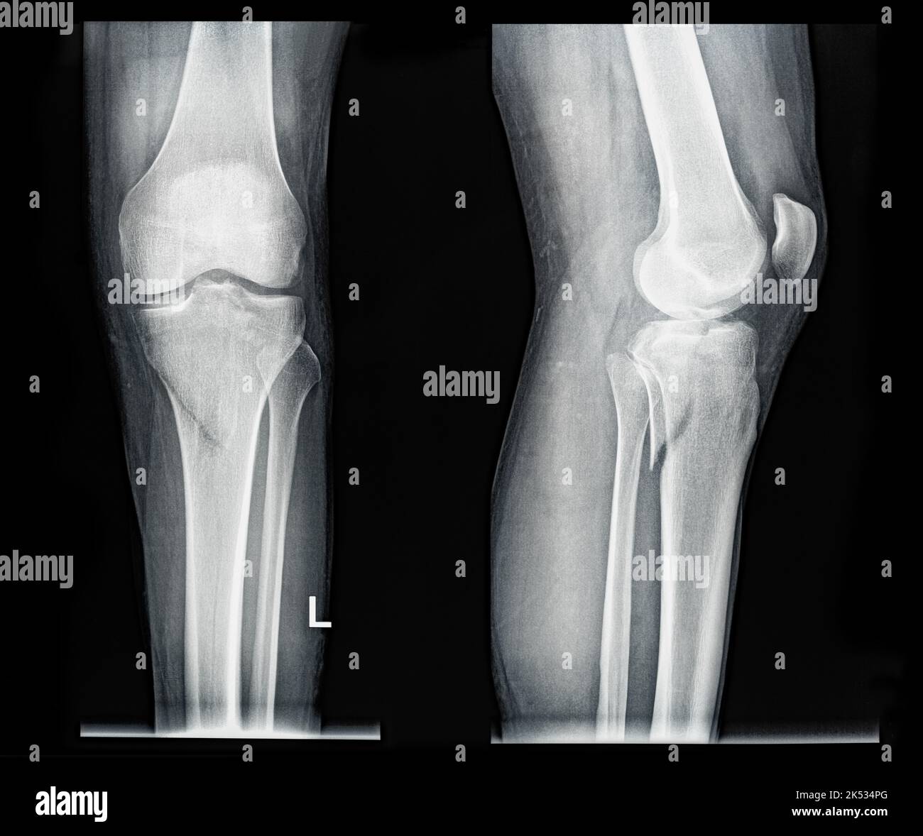 Xray MRI images showing real fracture of broken leg bone under the knee after injury Stock Photo