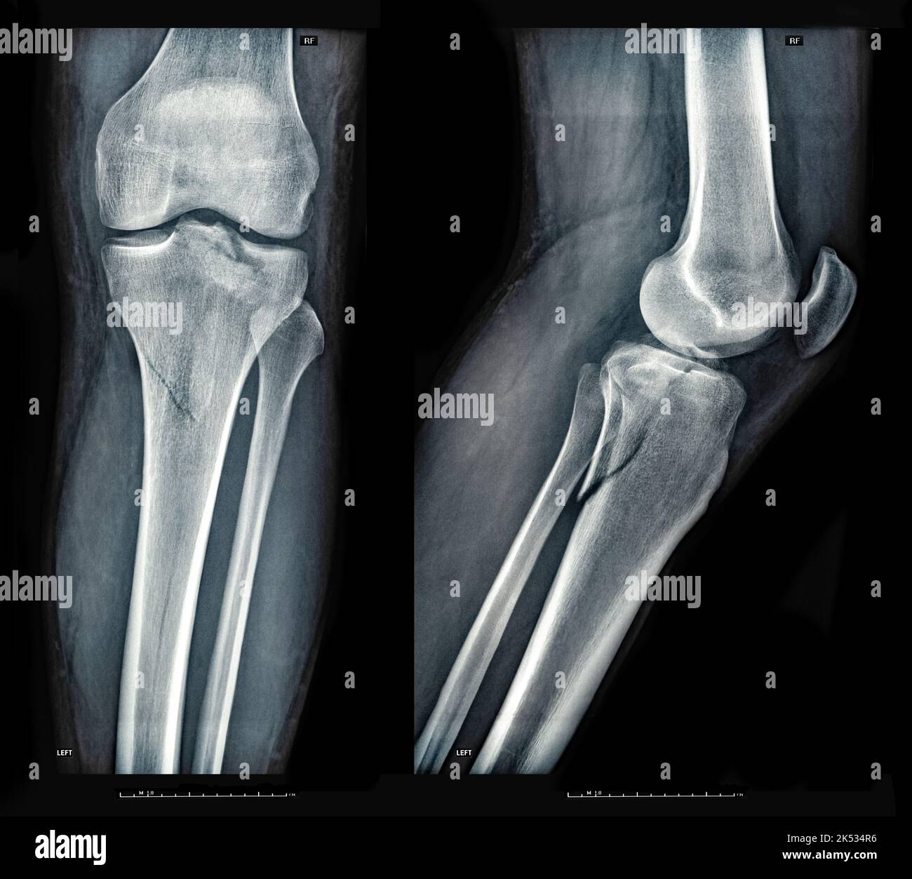 Xray images showing real fracture of broken leg bone under the knee after injury Stock Photo
