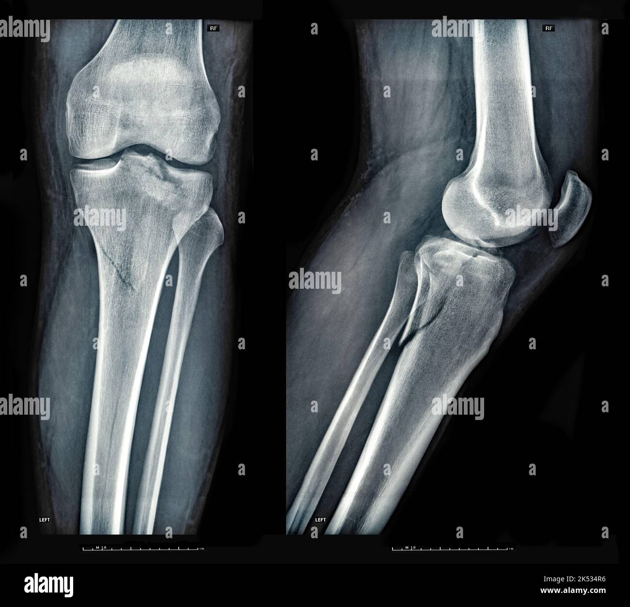 broken bone xray cartoon