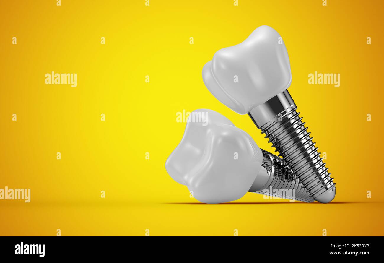 dental implants on a yellow background. 3d rendering Stock Photo Alamy