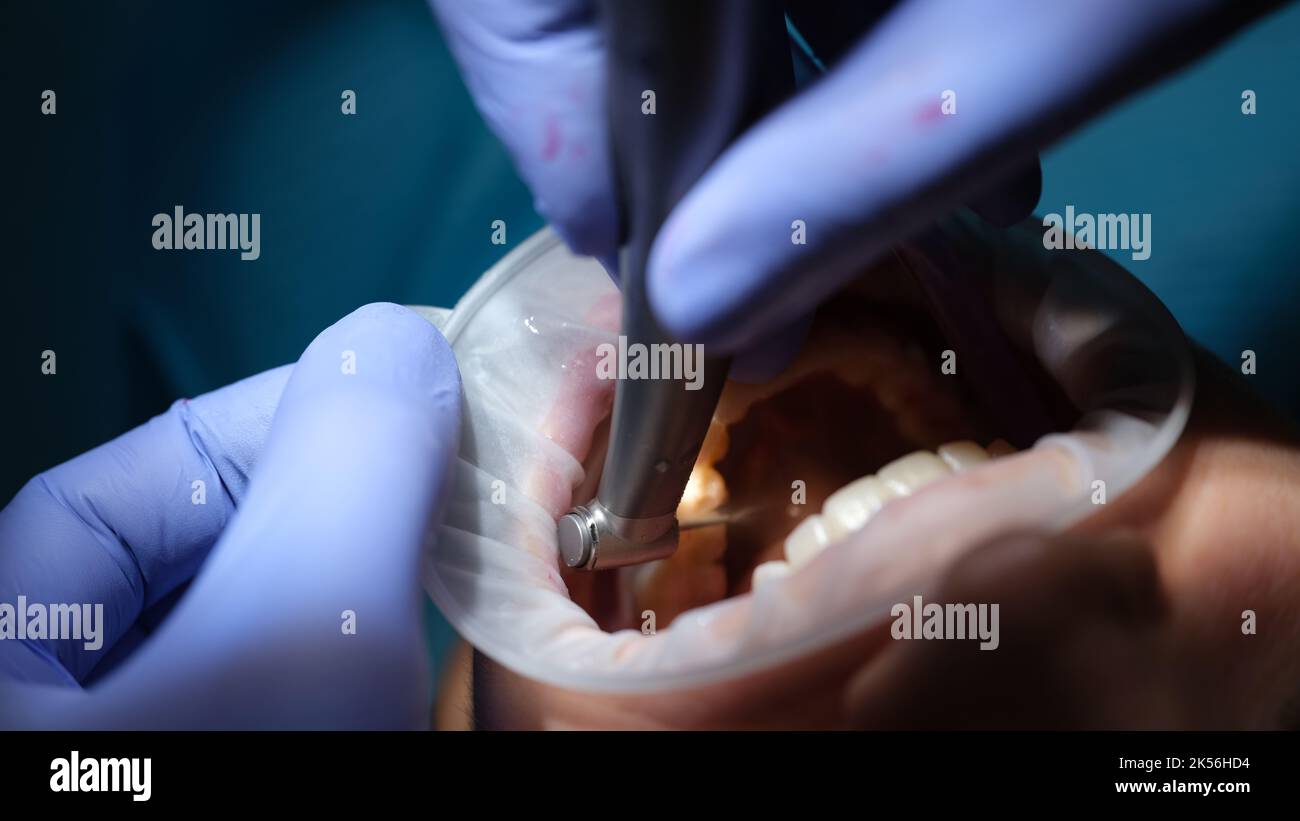Dentist drills tooth to patient in dental chair closeup Stock Photo - Alamy