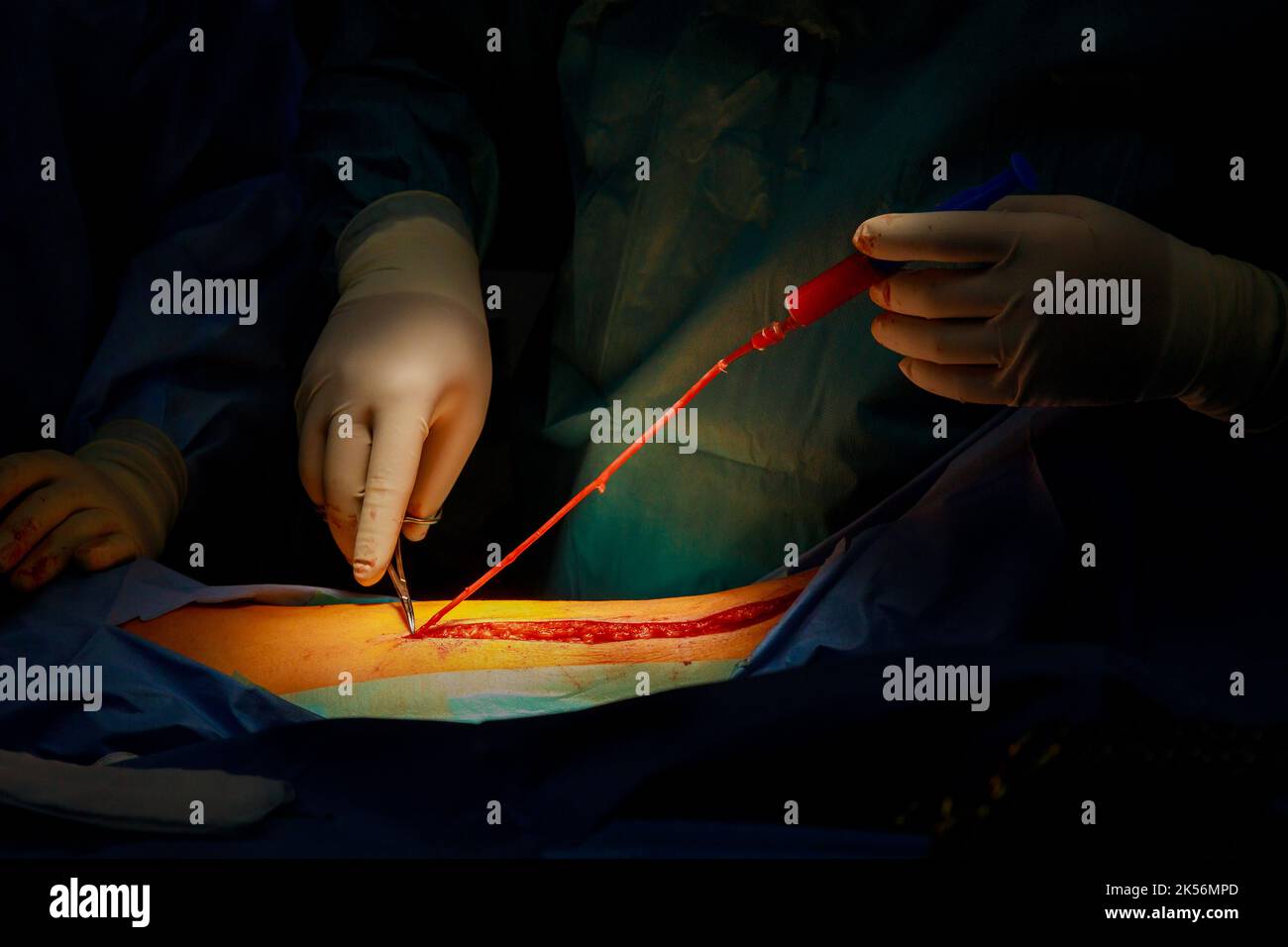 It is not uncommon for doctors in the operating room to sew up an injured leg Stock Photo