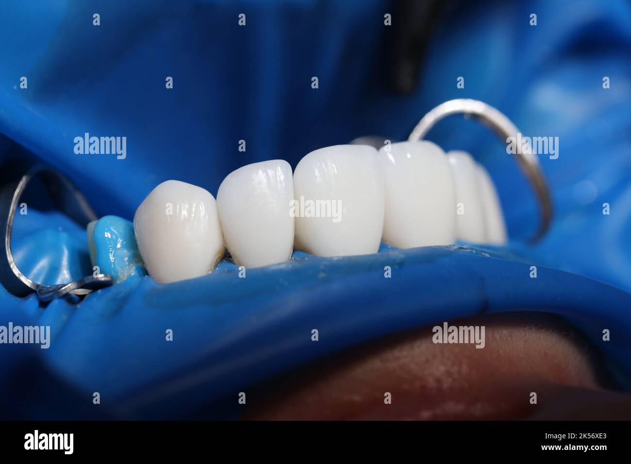 Installation of veneers and dental implants in clinic closeup Stock