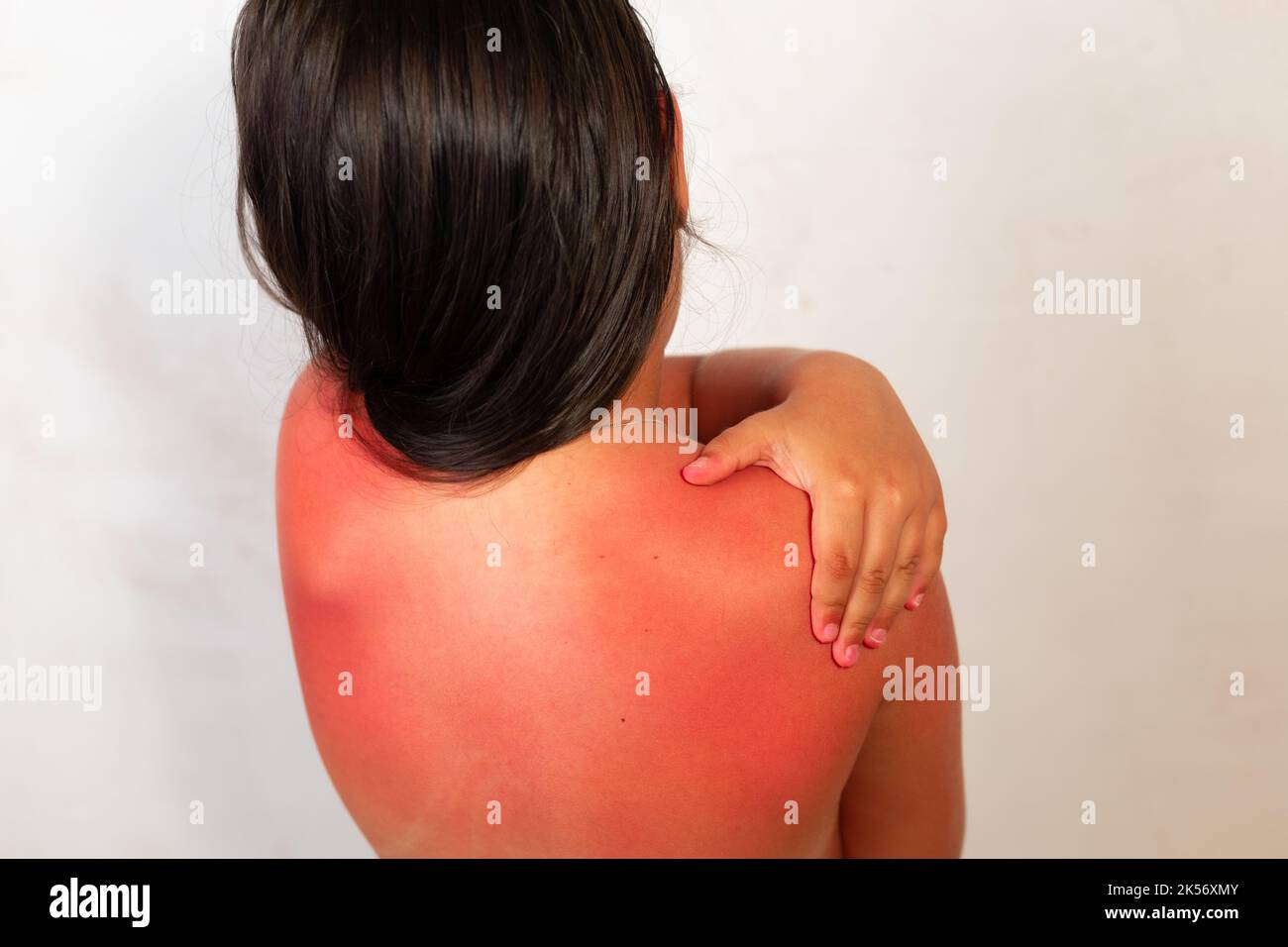 Back of long haired girl with severe red burns after spending time in sun, gray background. Child rub after sun cream with hand on inflamed areas of Stock Photo