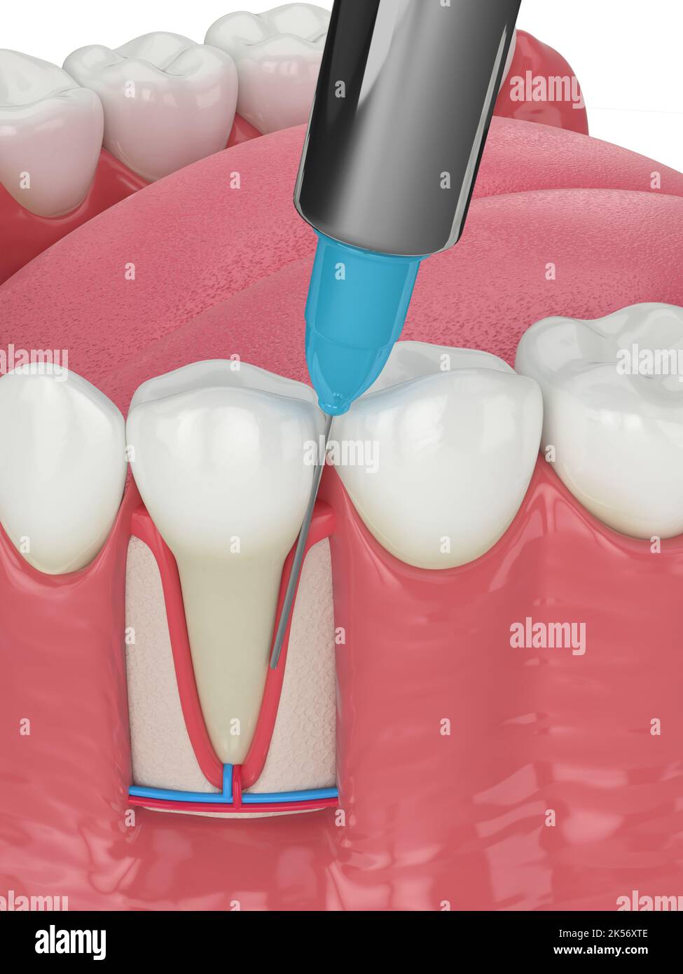 3d render of human jaw with intraligamentary anesthesia procedure over