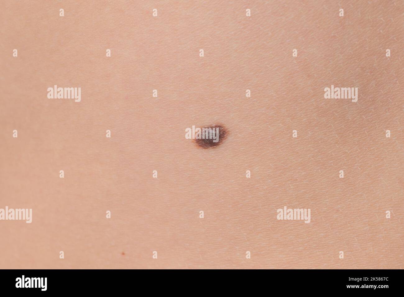 Brown warts on the child's body, the child's body and warts are brown