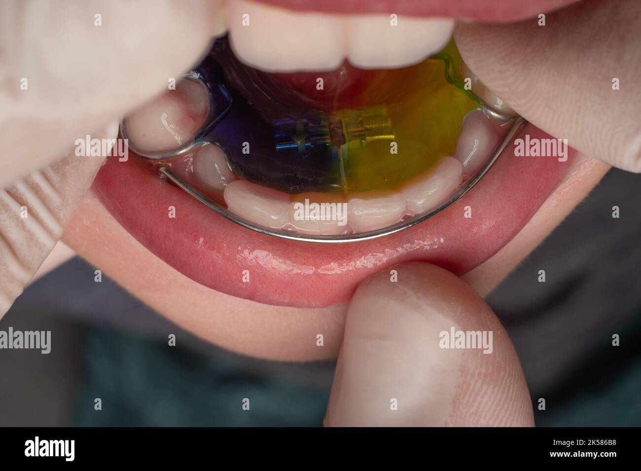 Plate for lower teeth, orthodontist and plate for teeth of the lower