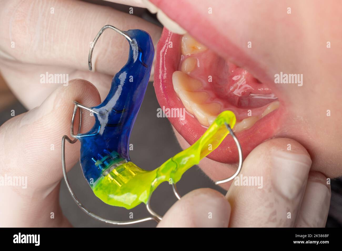 Plate for lower teeth, orthodontist and plate for teeth of the lower