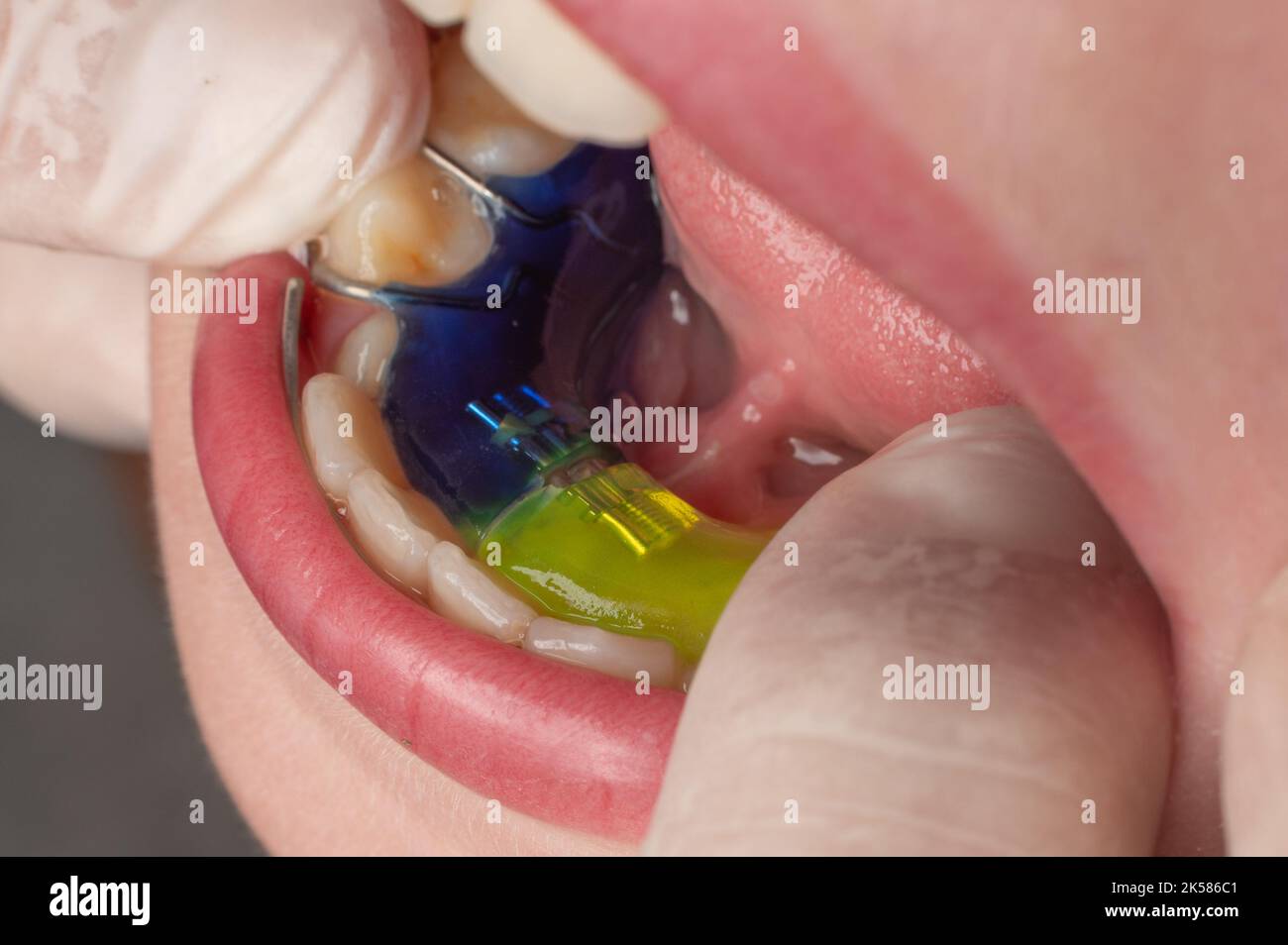Plate for lower teeth, orthodontist and plate for teeth of the lower jaw, child and plate Stock