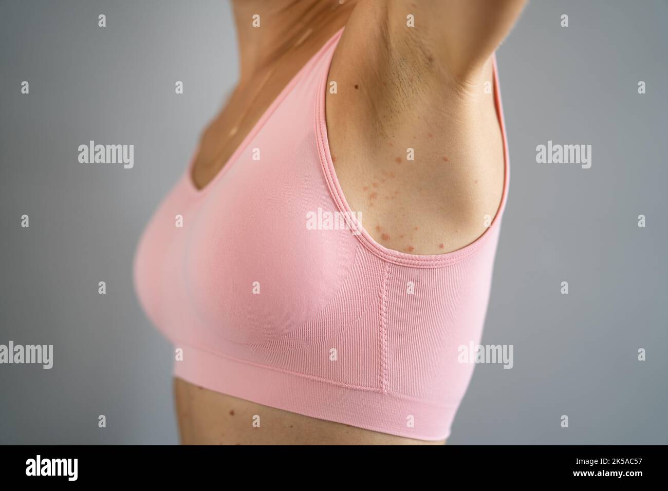 https://c8.alamy.com/comp/2K5AC57/woman-body-skin-rash-with-red-allergy-eruption-2K5AC57.jpg