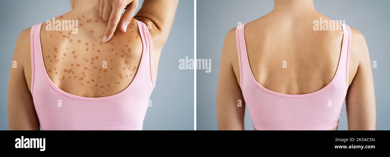 Psoriasis Disease Treatment Before After. Dermatology Skin Rash Stock Photo