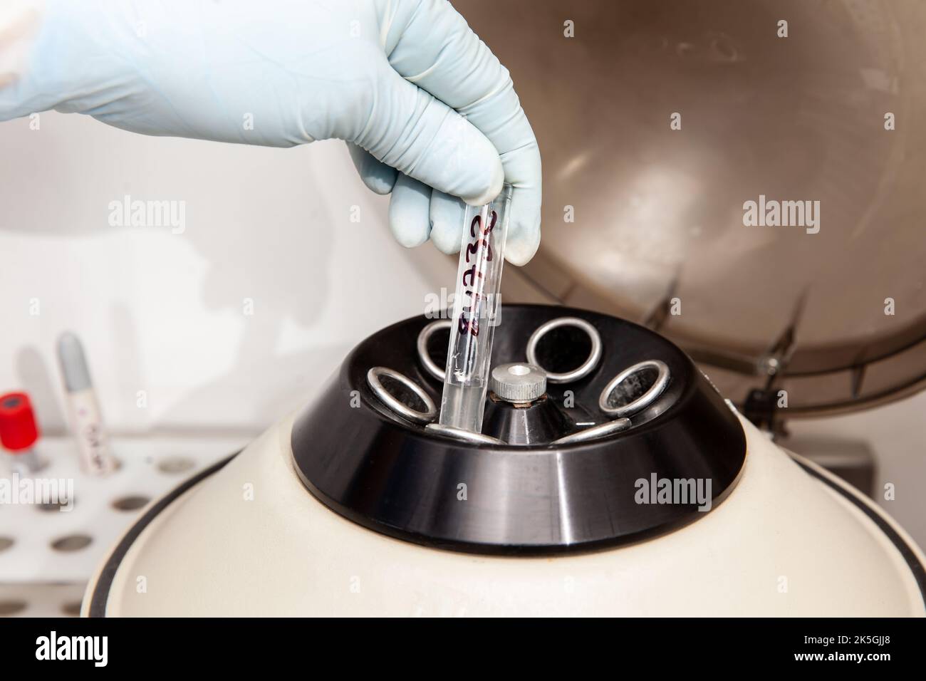 Scientist preparing a peritoneal fluid sample for cytology analysis in