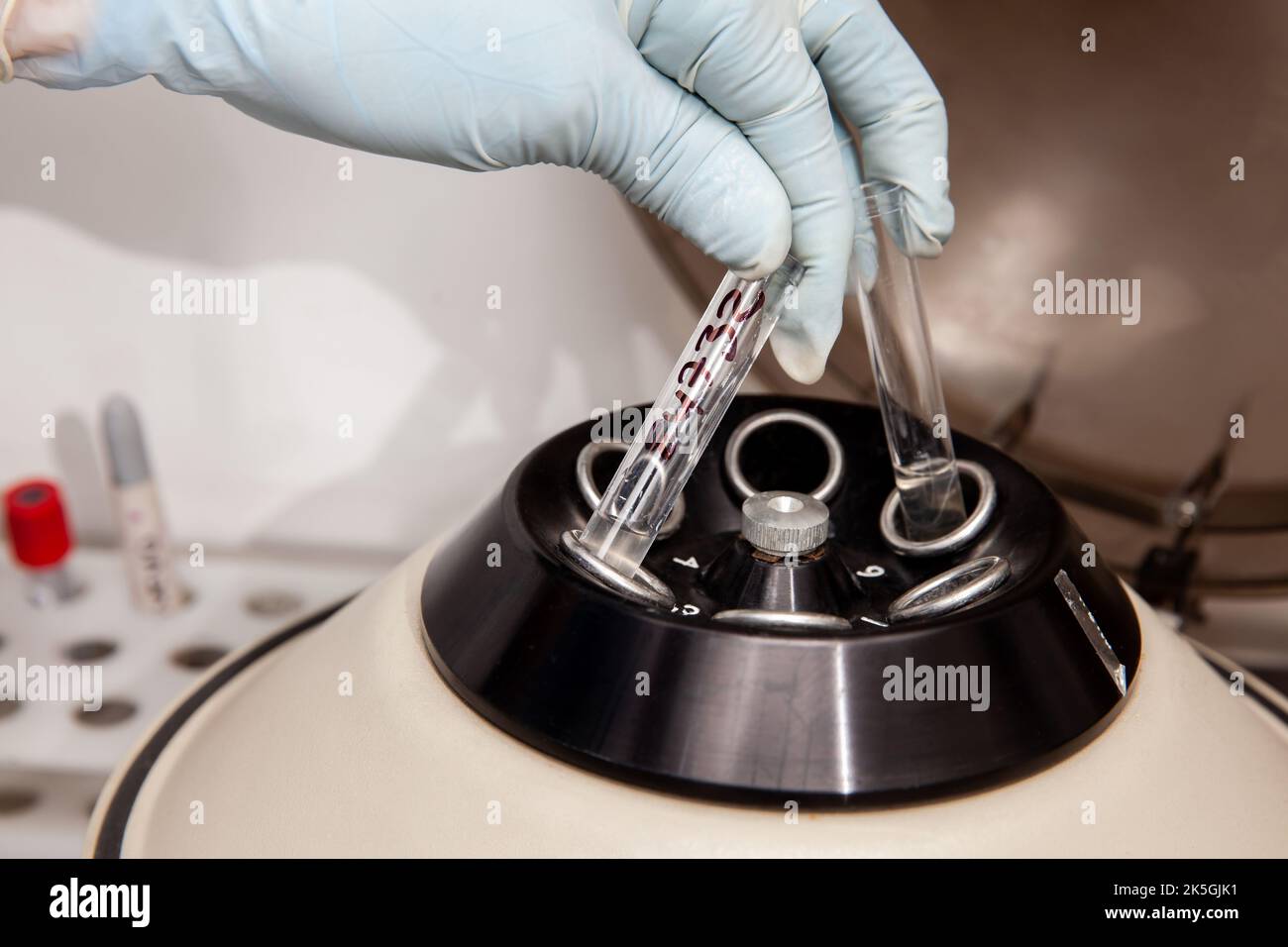 Scientist preparing a peritoneal fluid sample for cytology analysis in