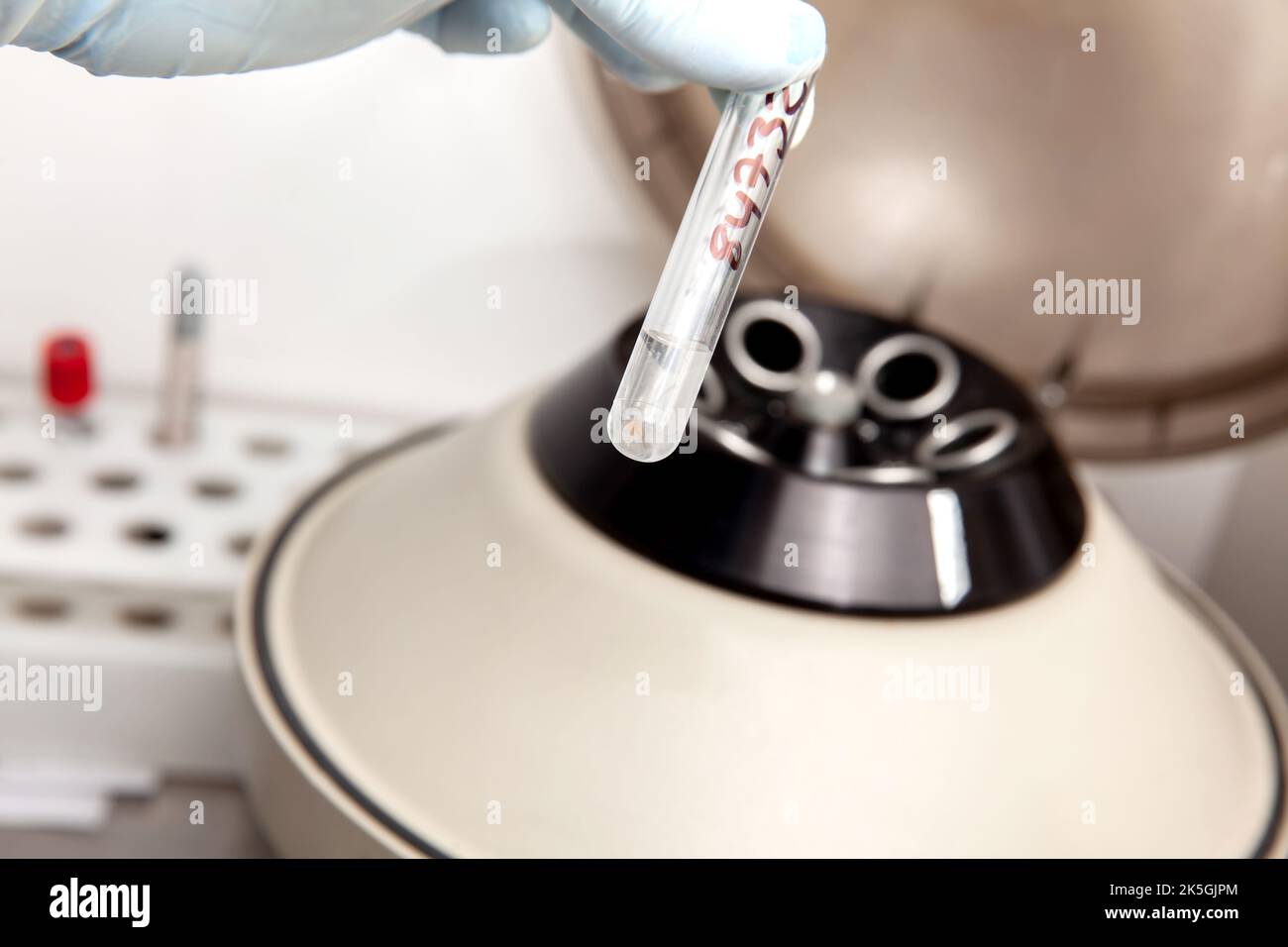 Scientist preparing a peritoneal fluid sample for cytology analysis in the laboratory. Cancer diagnosis concept. Medical concept. Stock Photo
