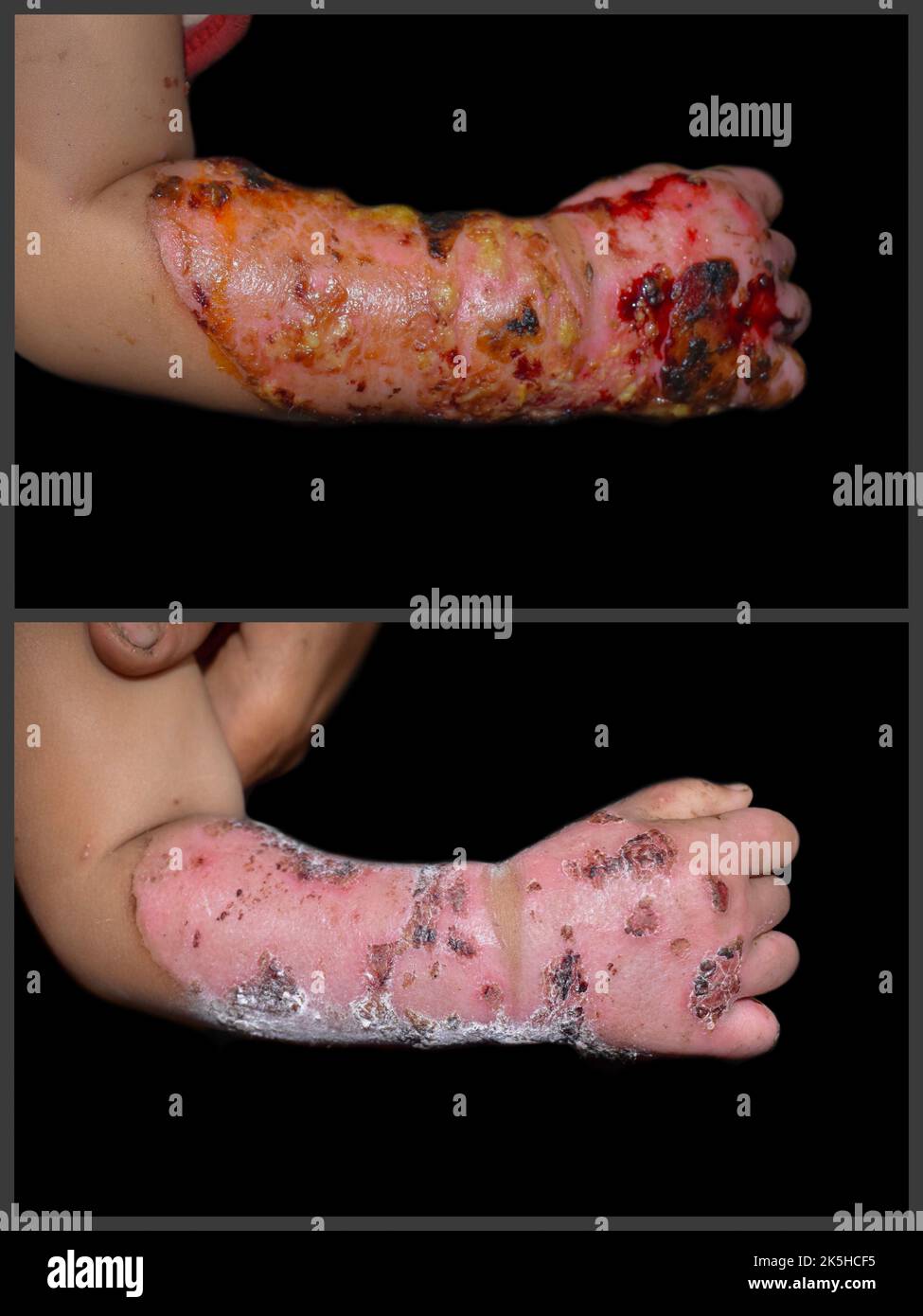 Third degree burn hi-res stock photography and images - Alamy