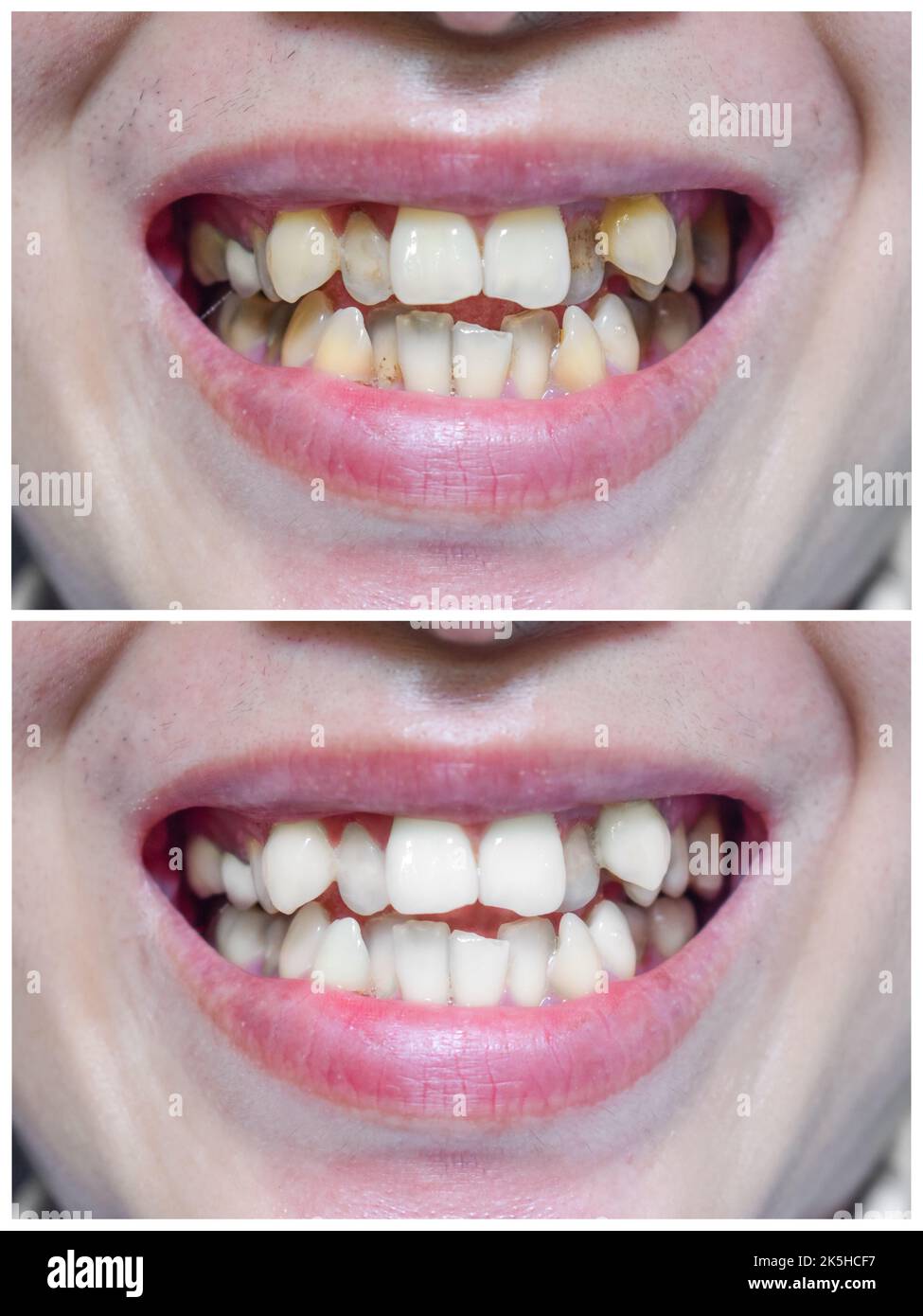 Before and after scaling and polishing treatment of tobacco stains on crowded teeth of Asian