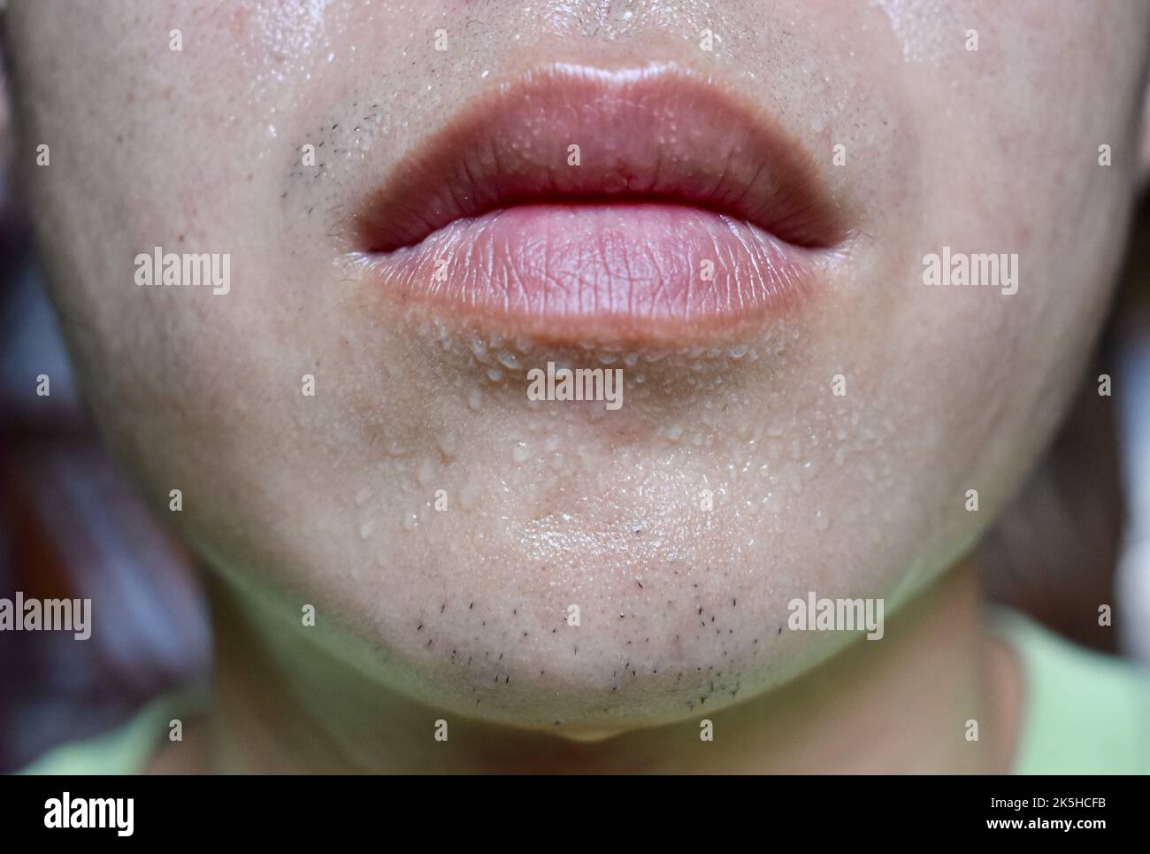 Excessive sweating or hyperhidrosis and oily skin at face of Southeast Asian, adult young man. Oily skin is the result of overproduction of sebum from Stock Photo