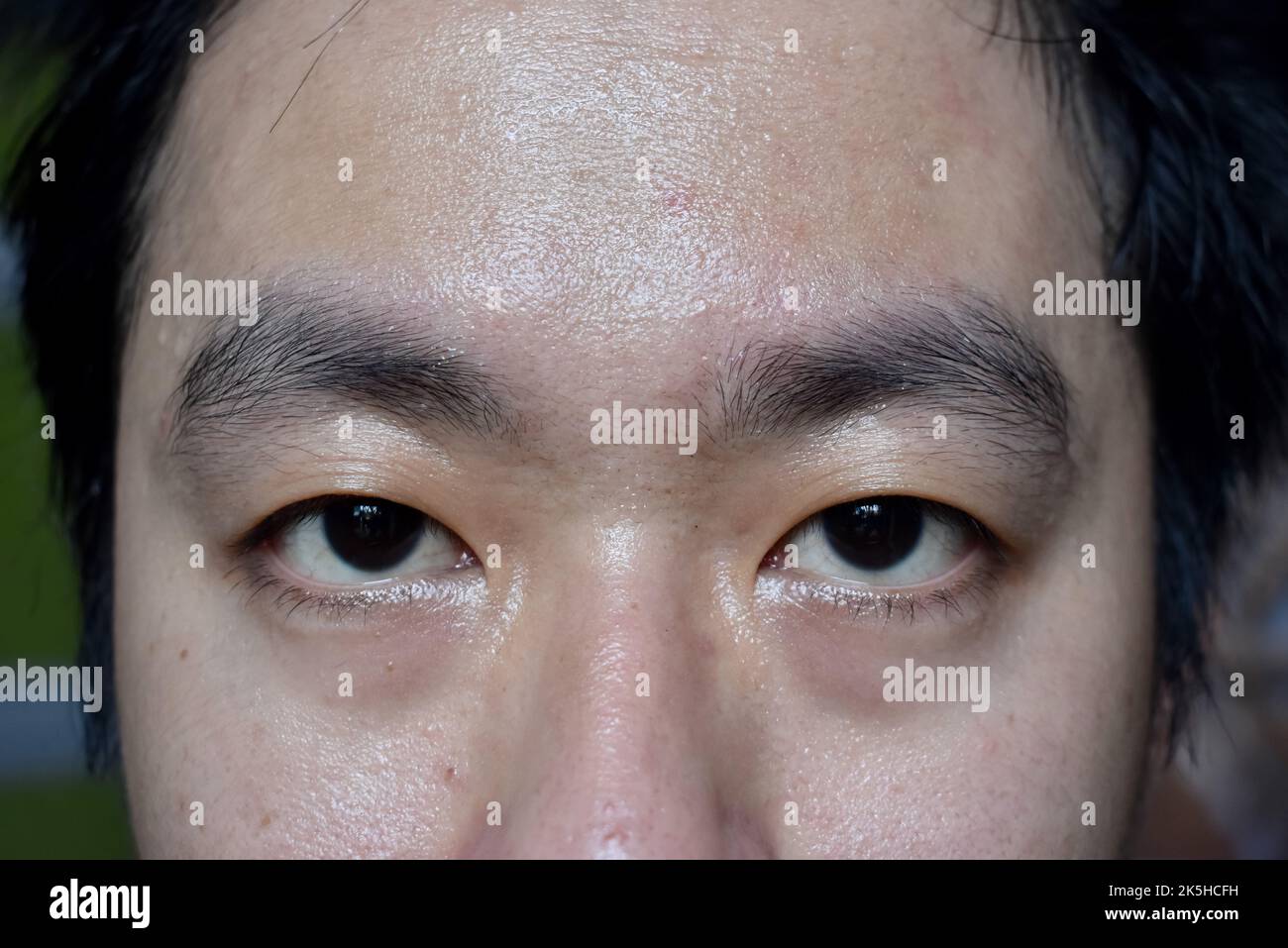 Excessive sweating or hyperhidrosis and oily skin at face of Southeast Asian, adult young man. Oily skin is the result of overproduction of sebum from Stock Photo