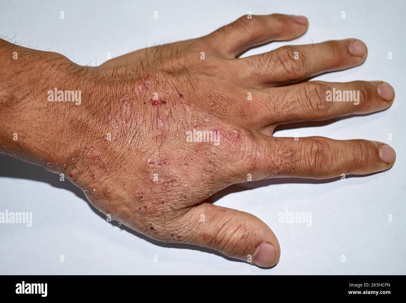 Itchy skin lesions in hand of Asian adult man. It may be caused by scabies infestation or fungal infection. Stock Photo