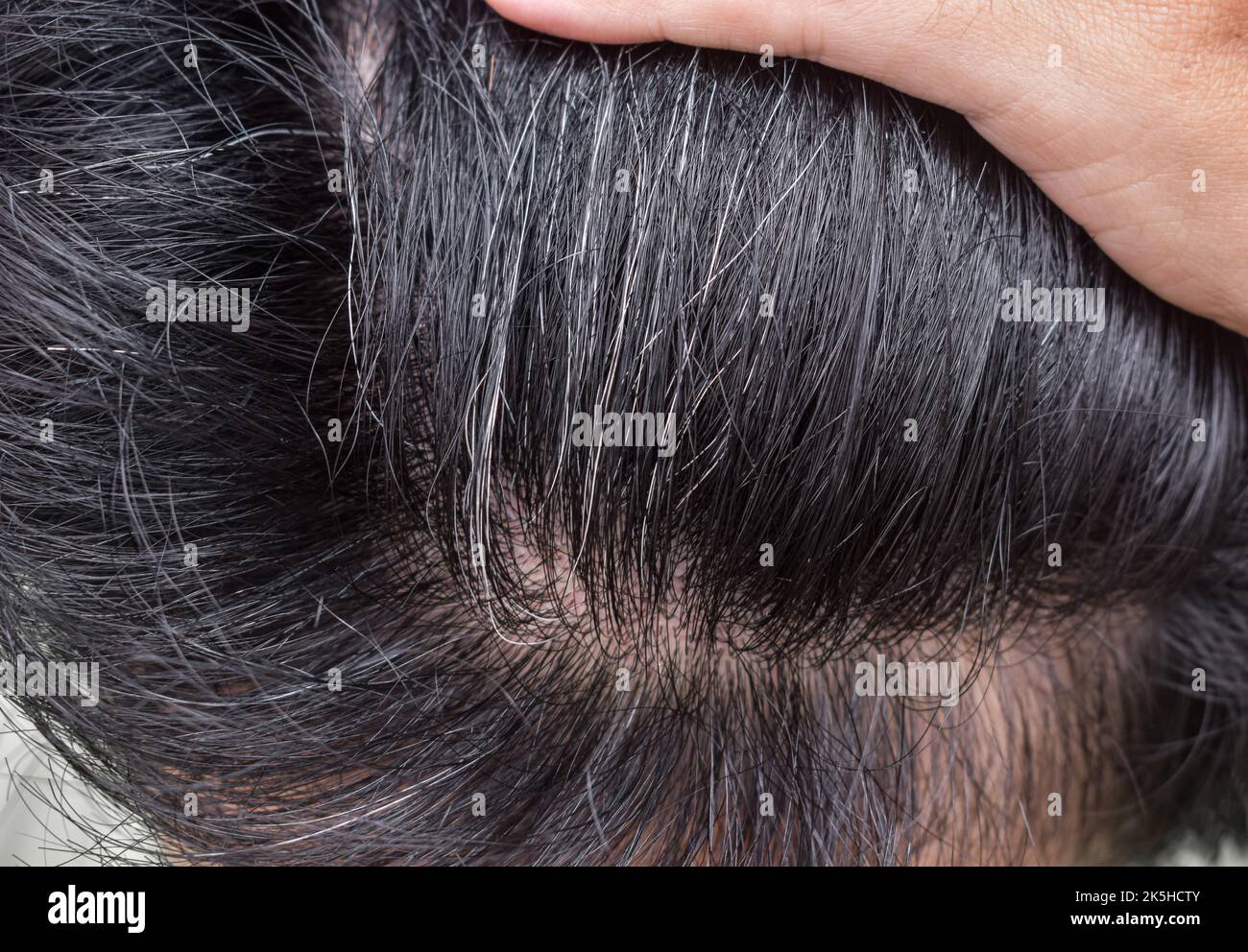 Premature hair whitening. Early aging. Grey colored changes of hair in Asian young man. Stock Photo