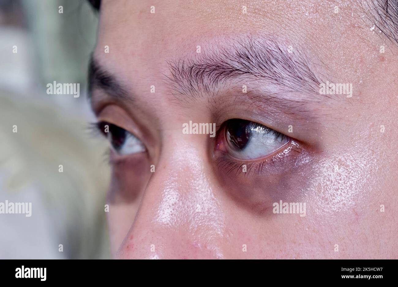 Raccon eyes or periorbital ecchymosis or panda eye sign in Southeast Asian male patient. It is a sign of basal skull fracture or subgaleal hematoma. Stock Photo