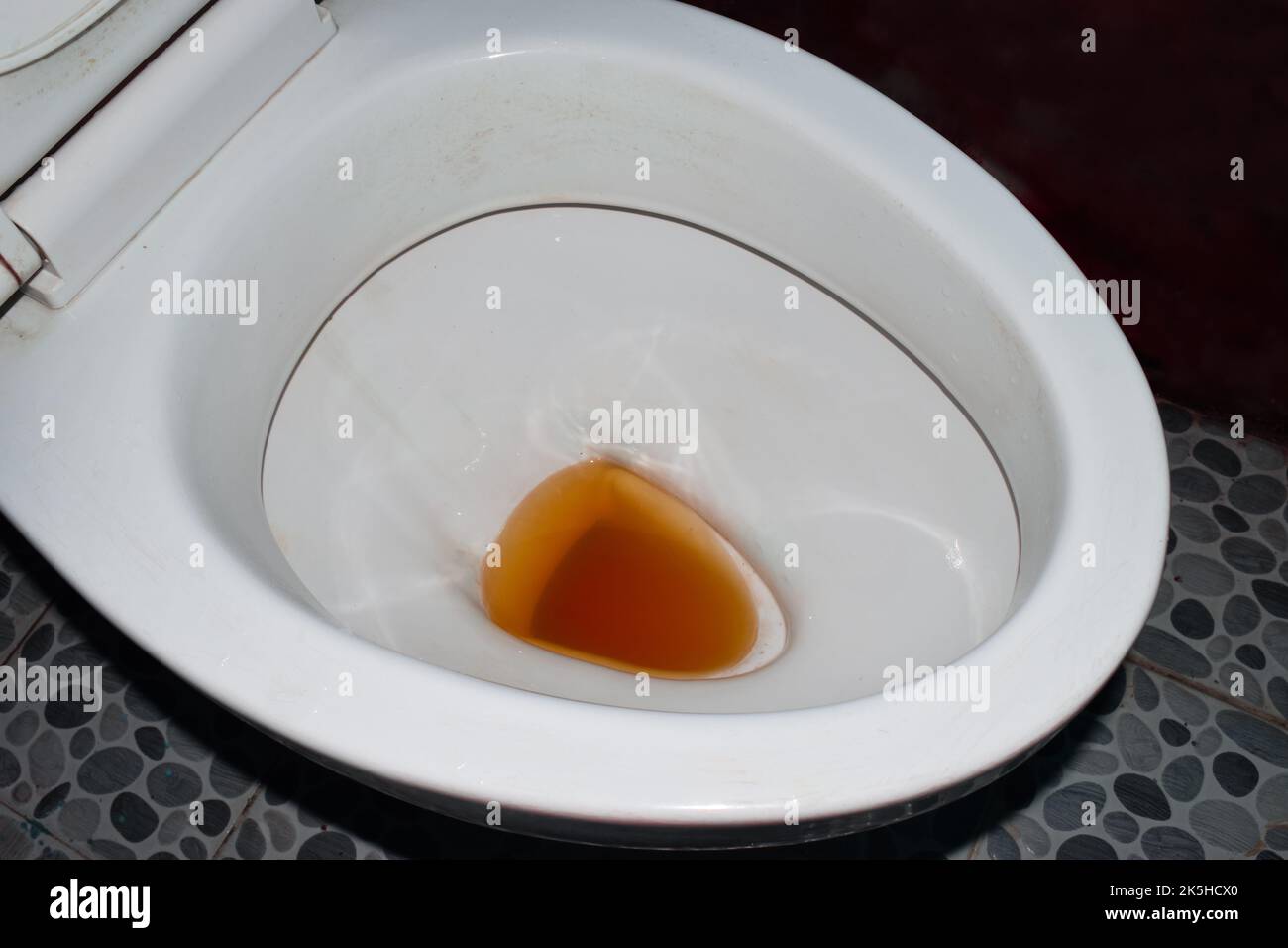 High coloured urine in toilet. High colored urine occurs in hepatitis