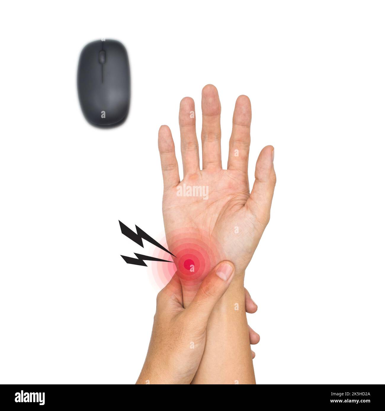 Mouse hand syndrome in Asian young man. Pain at the base of hand or