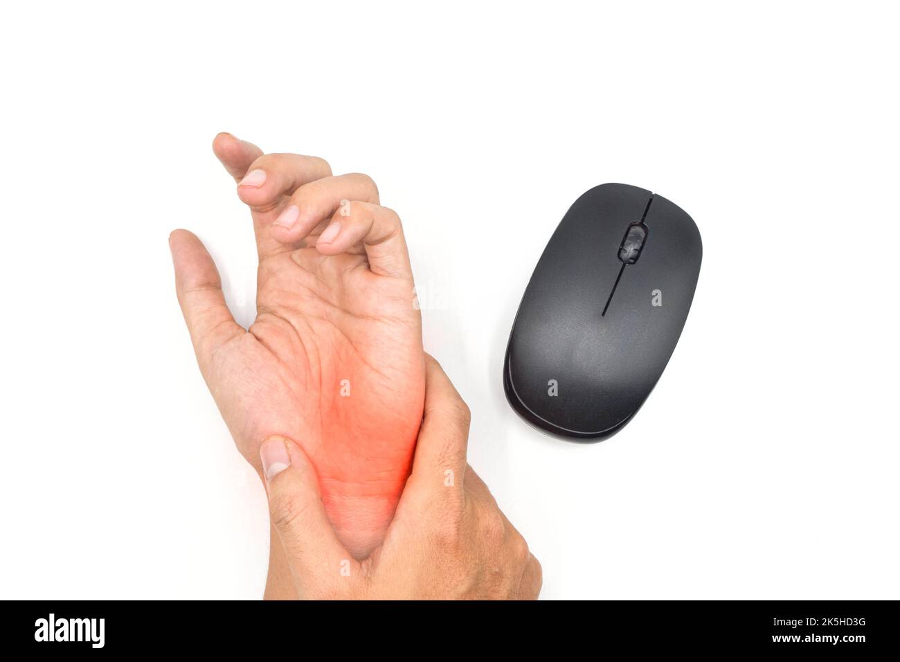 Mouse hand syndrome in Asian young man. Pain at the base of hand or