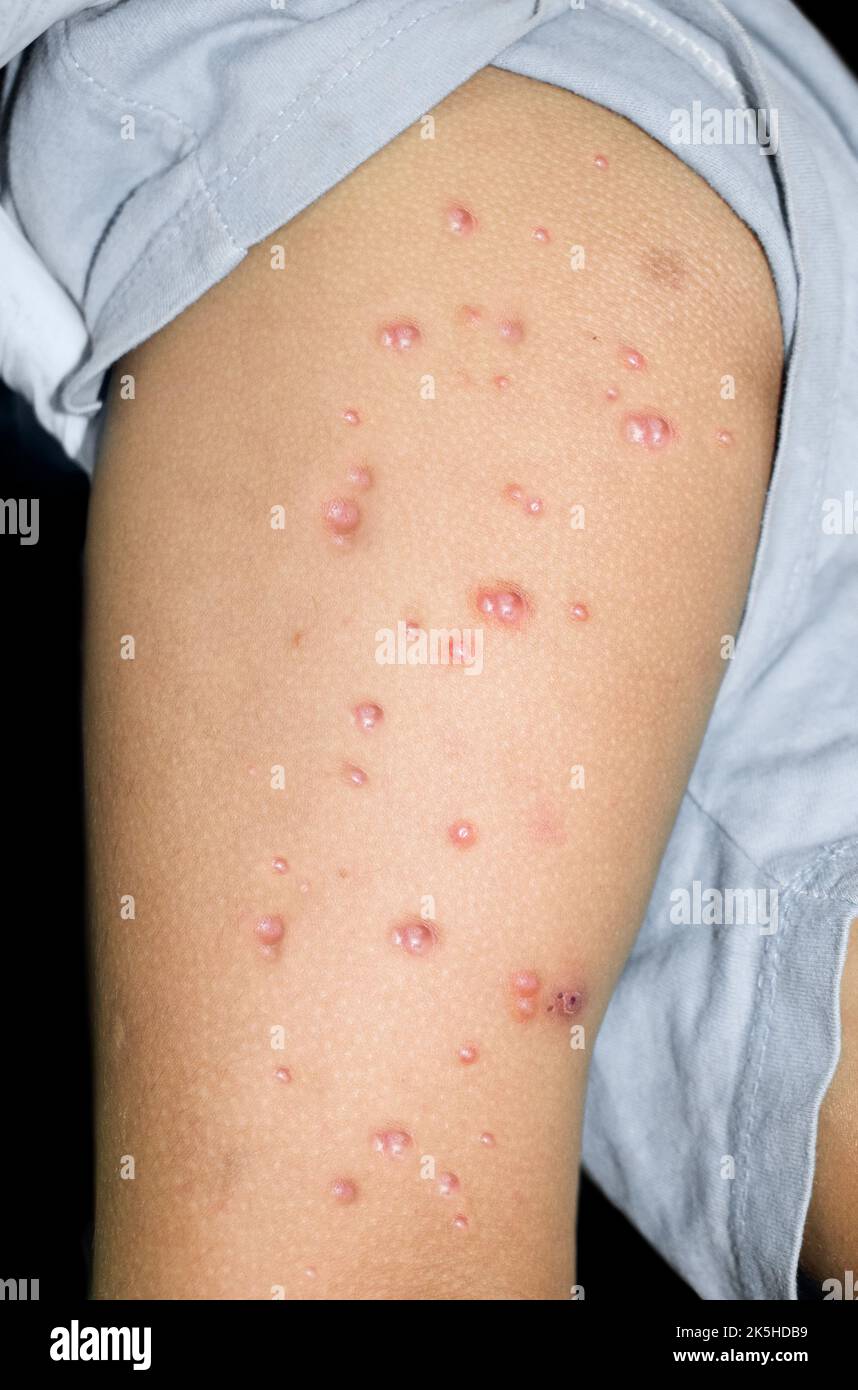 Monkeypox lesions in the thigh of Asian, Burmese Child. Stock Photo