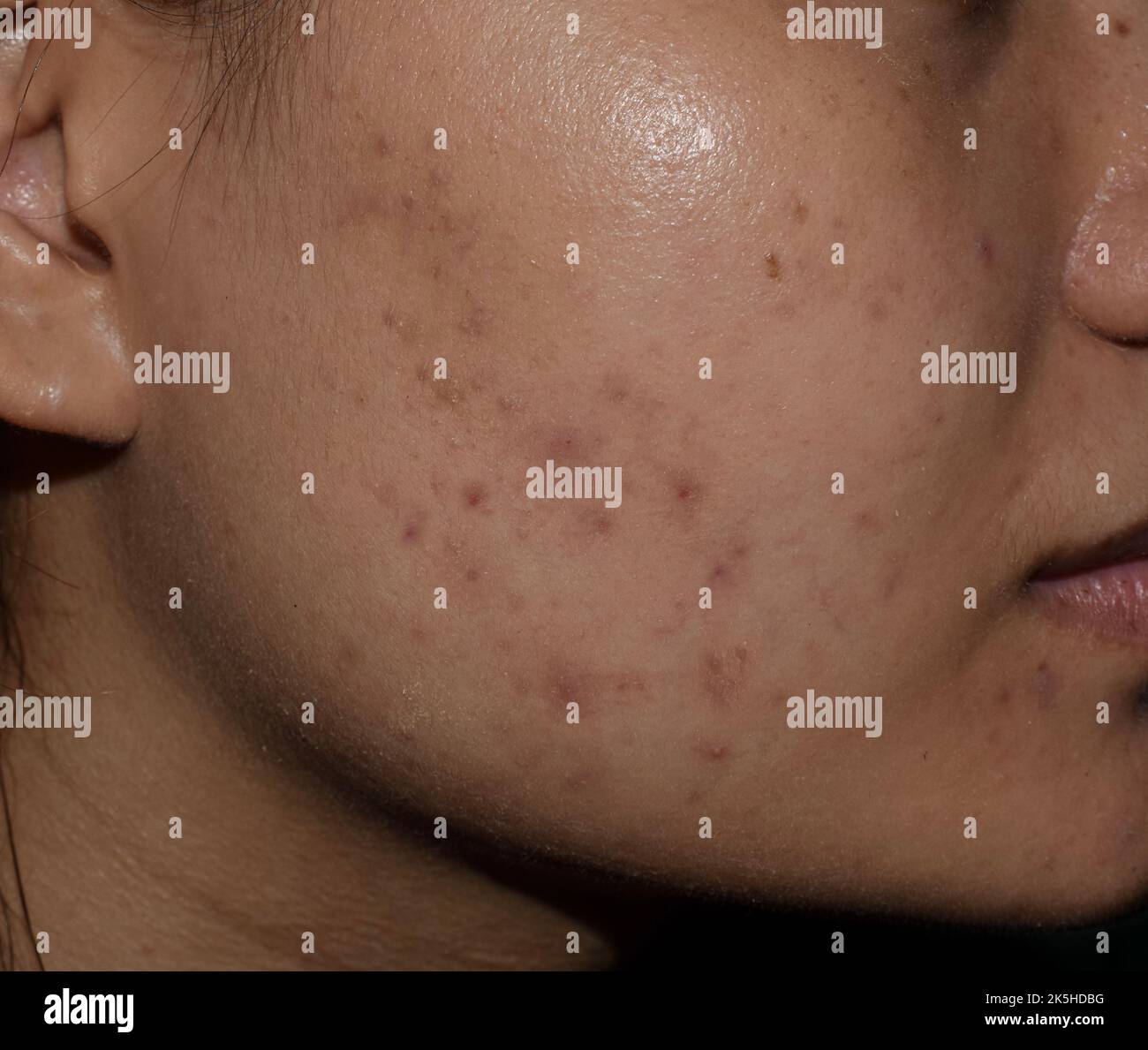 acne-black-spots-and-scars-on-face-of-asian-young-woman-stock-photo