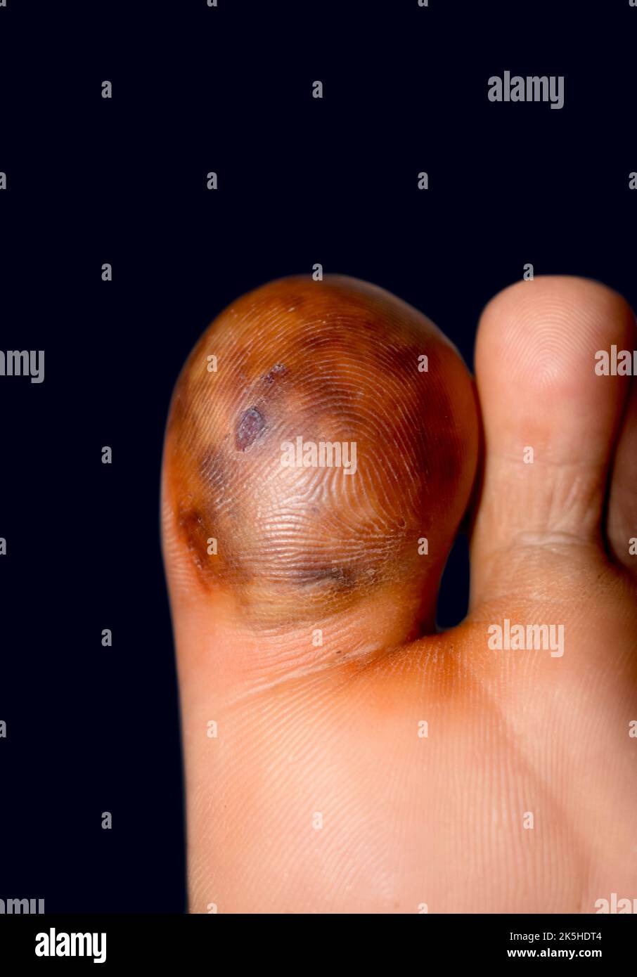 Abscess with surrounding cellulitis or Staphylococcal, Streptococcal skin infection at big toe of Asian Burmese male patient. Stock Photo