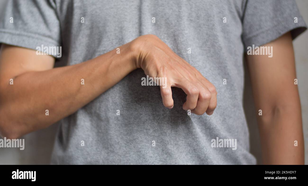 Volkmann contracture in left upper limb of Southeast Asian young man. It is a permanent shortening of forearm muscles that gives rise to a clawlike po Stock Photo