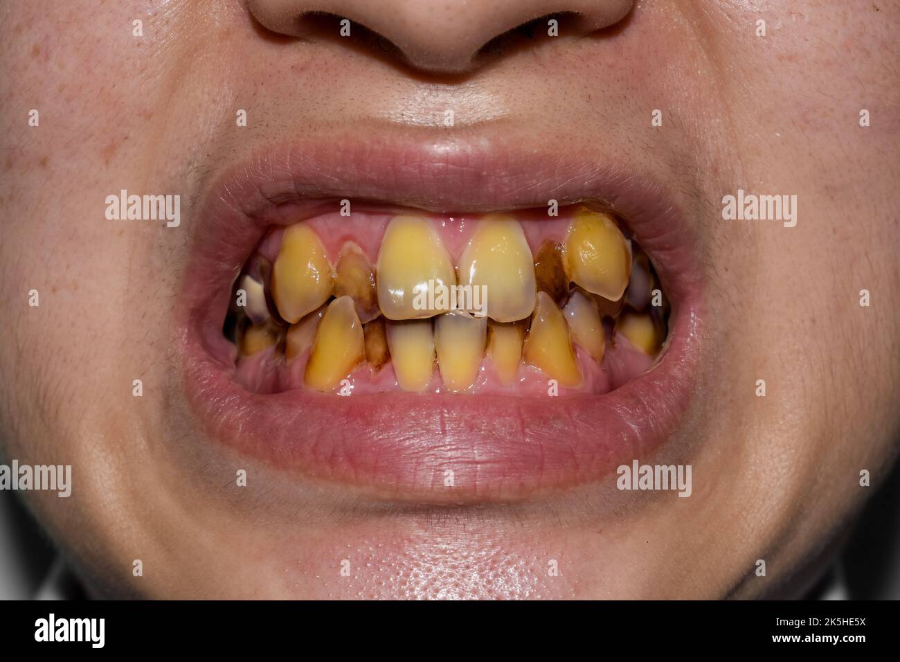 Chewing tobacco teeth hires stock photography and images Alamy