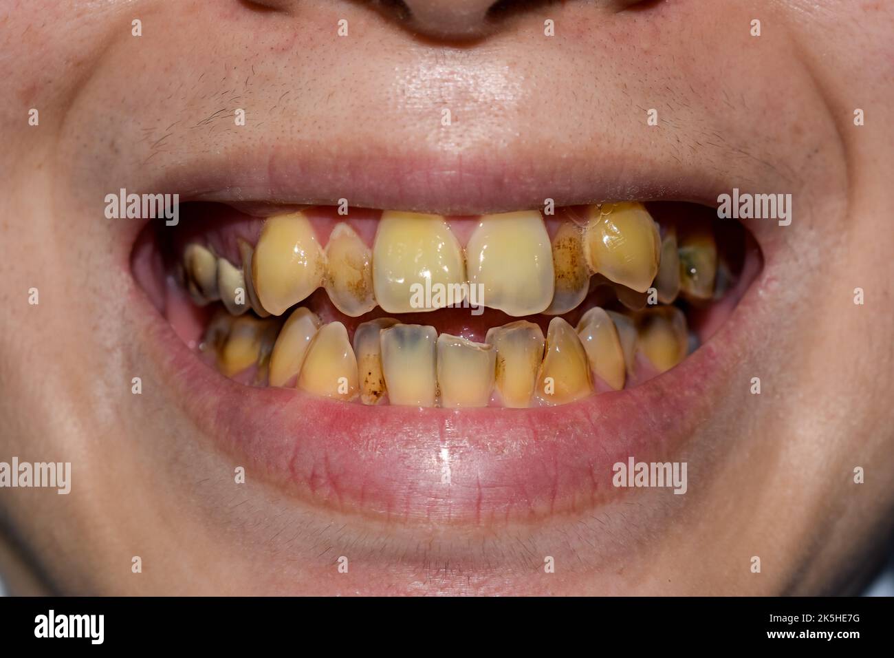 Chewing Tobacco Teeth Stains at Linda Dixon blog